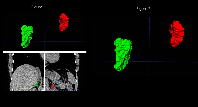 Chronic Stress's Impact on Cancer Progression | Mirage News
