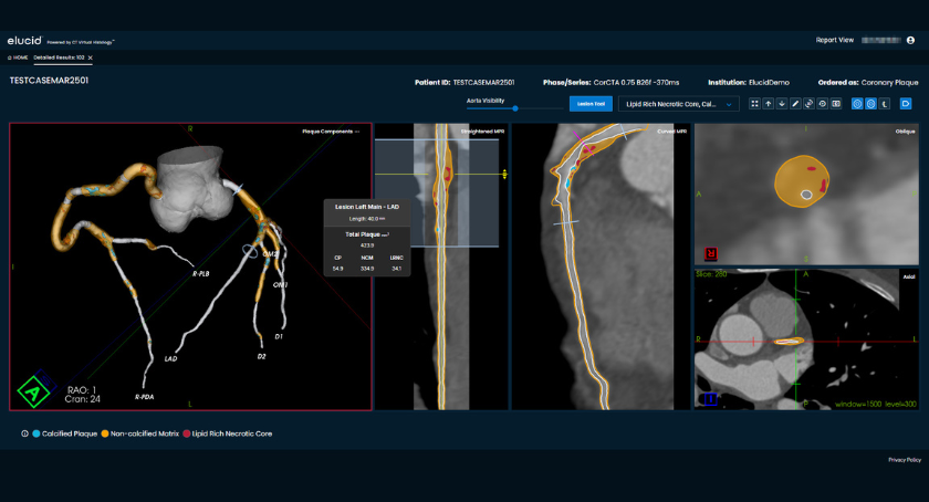 Elucid Augments its Plaque-IQ Software Suite